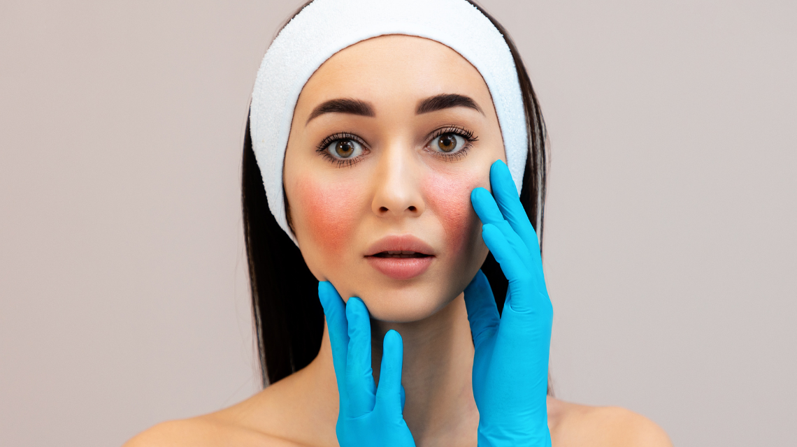 Couperose: cause e trattamenti